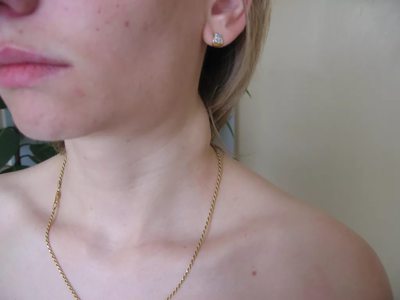 Как лечить ангину с воспаленными лимфоузлами Как лечить ангину с воспаленными лимфоузлами