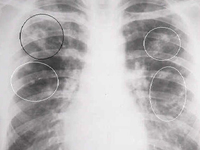 Заболевание туберкулома легких