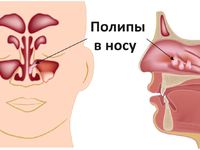 Что такое полипоз носа