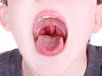 Как вылечить ребенку красное горло