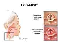 Ларингит - воспаление голосовых связок