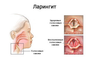 Ларингит - воспаление голосовых связок