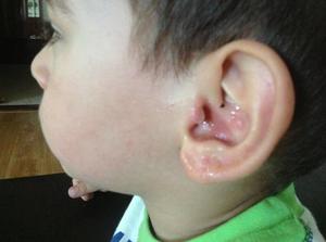 Мочка уха у ребенка с шишкой - в чем причина