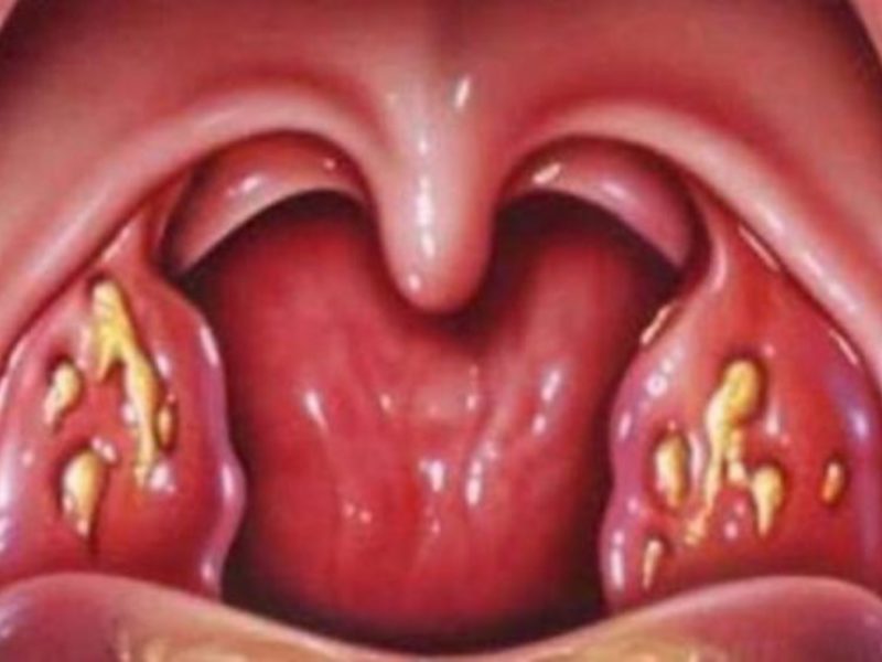 Заболевания горла