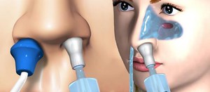 Как протекает процедура промывания носа