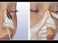 Ринопластика при переломе костей носа