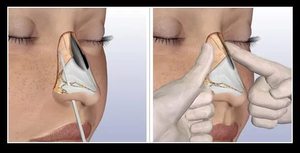 Ринопластика при переломе костей носа