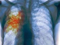 Что такое туберкулез легких