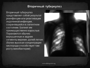 Как лечить туберкулез легких