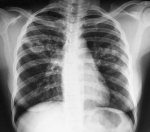  Туберкулез легких на рентгеновском снимке