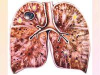 Как передается туберкулез легких от одного человека к другому