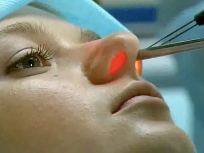 Прижигание слизистой носа лазером: возможные последствия процедуры по операции в носовых сосудах
