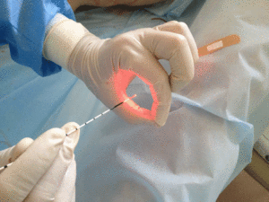 Последствия операции по прижиганию сосудов в носу