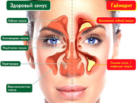 Воспаленая полость носа