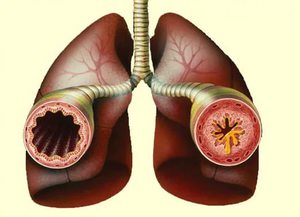 Фенспирид принимается снимает симптомы астмы