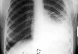 На рентгене туберкулезный плеврит