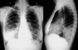 Рентгеновский снимок больного пневмонией