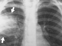 На рентгеновском снимке пневмония