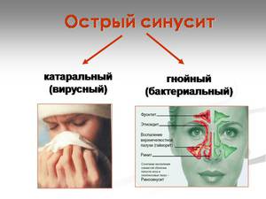 Заболевание области носовых пазух