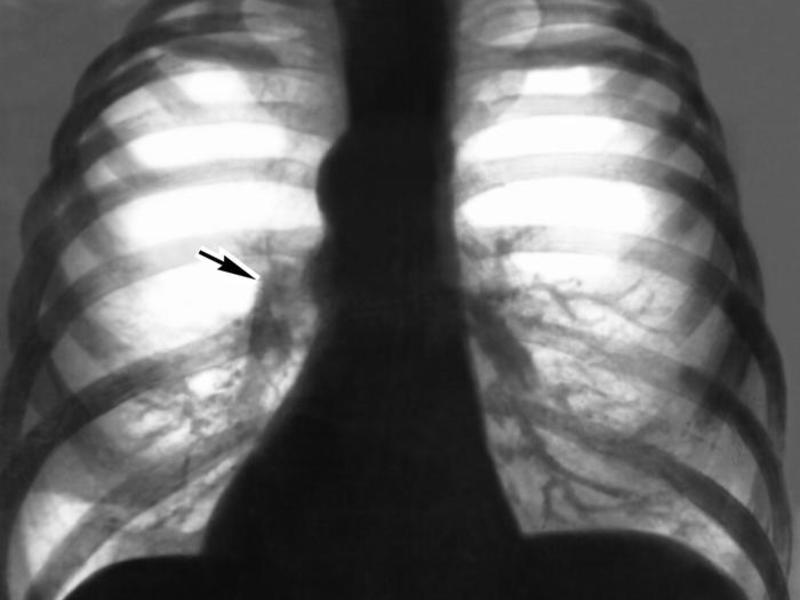 Рентген больного эмфиземой легких