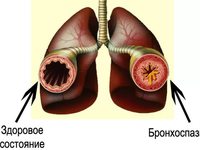 Симптоматика бронхоспазма