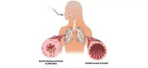 Заболевание бронхиальная астма