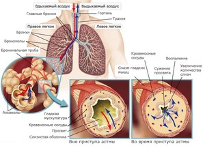Почему возникает бронхиальная астма