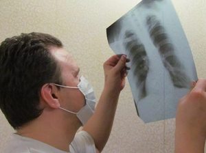 Туберкулез на рентгеновском снимке