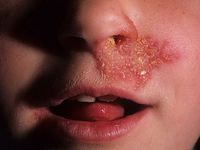 Болячки в носу у ребенка