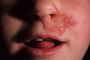 Болячки в носу у ребенка