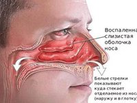 Причины воспаления слизистой носа