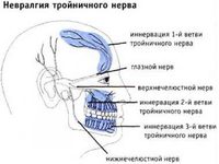 Невралгия тройничного нерва