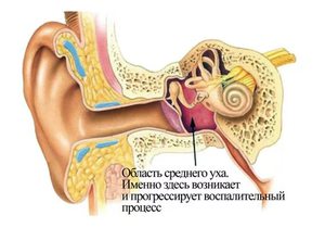 Препараты для лечения заложенности в ушах