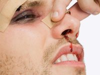 Как определить сломан ли нос