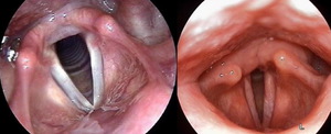 Фиброларингоскопия - диагностика заболеваний горла