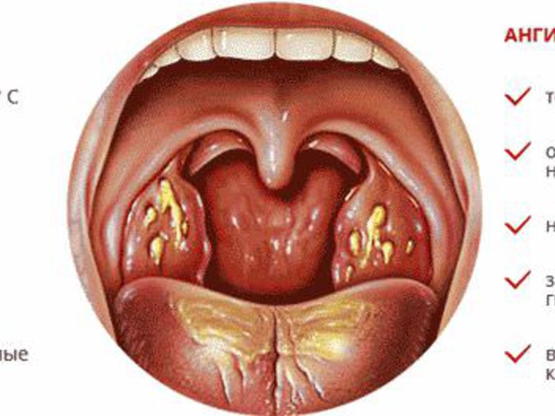 Симптомы катаральной ангины