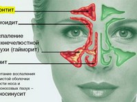 Описание воспалительного заболевания носовой полости риносинусита