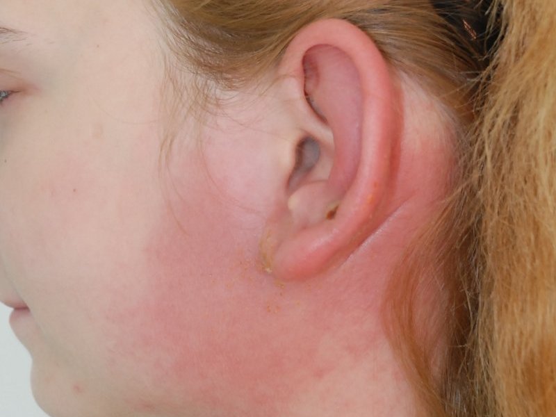 Возможные дополнительные признаки воспаления лимфоузла за ухом