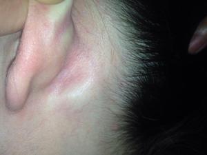 Особенности лечения воспаления лимфоузлов за ушами