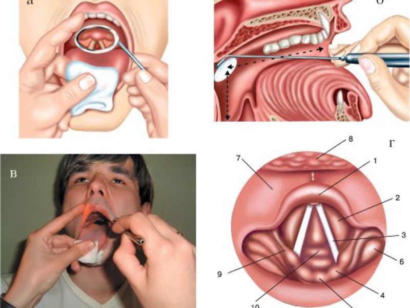 Причины абсцесса в горле